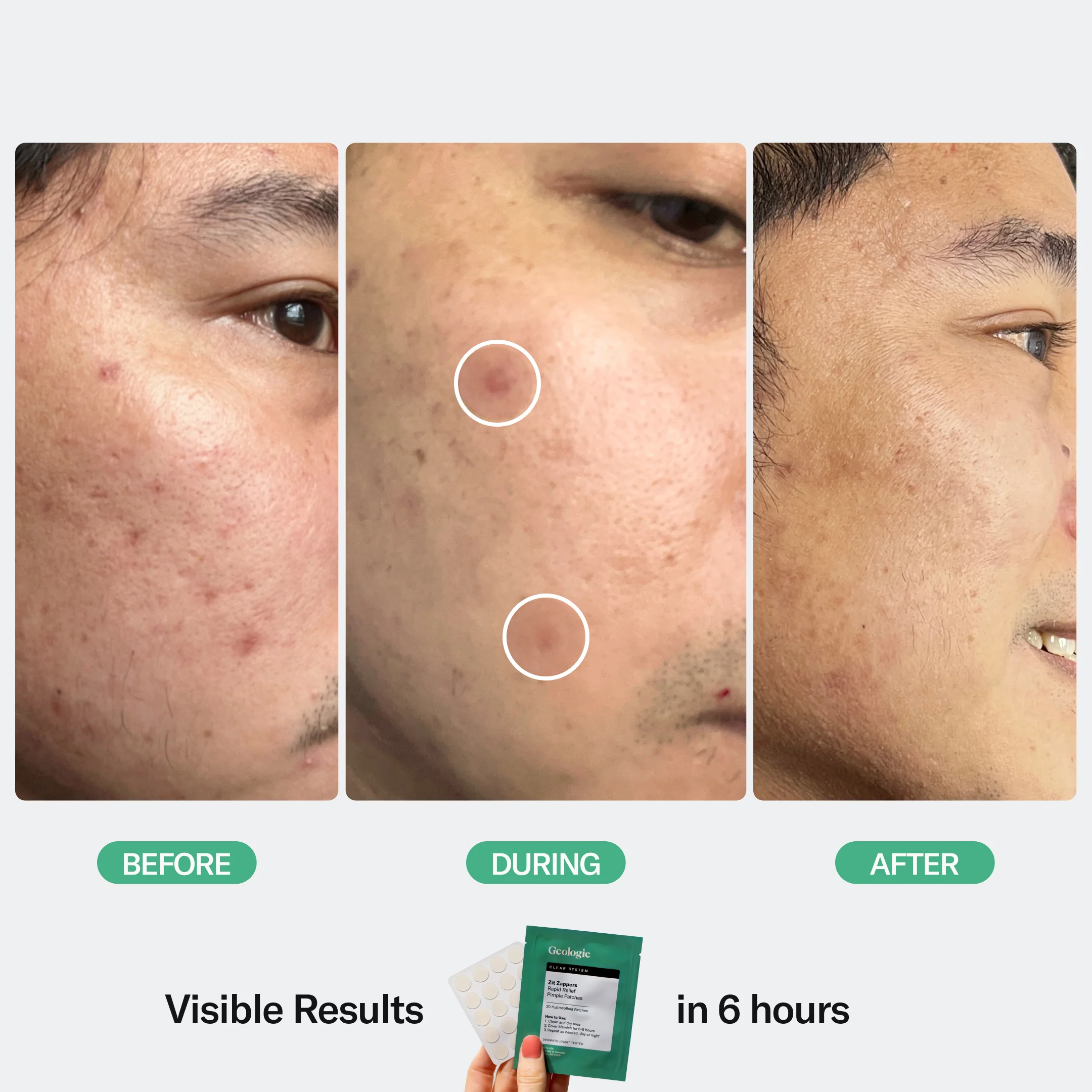 Zit Zapper Pimple Patches - Image 7
