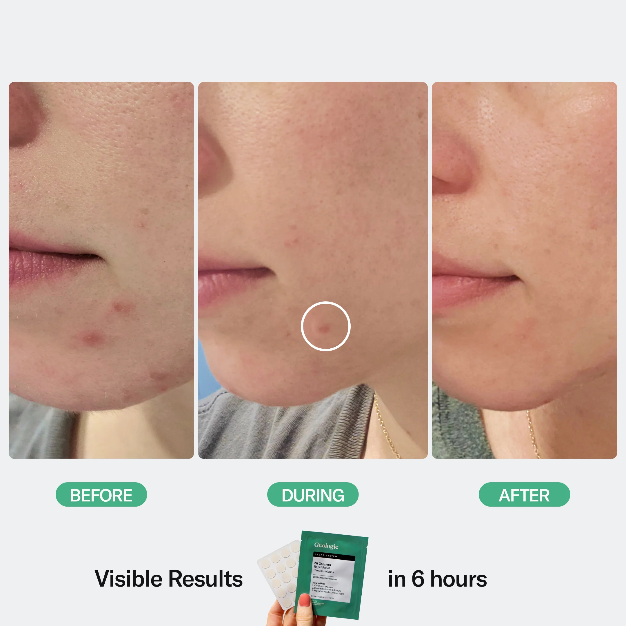 Zit Zapper Pimple Patches - Image 8